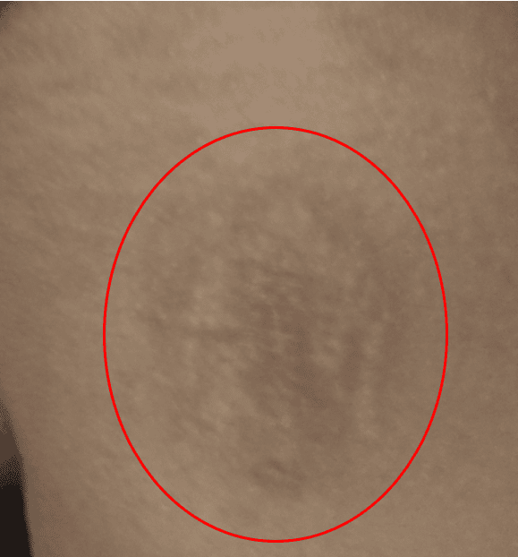 discolored skin on a person's thigh 