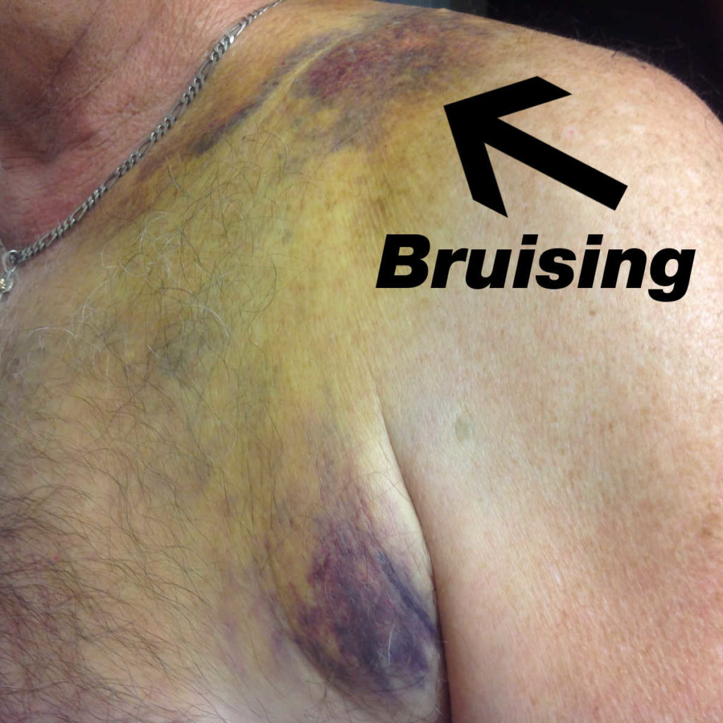 bruising to motorcycle rider's chest after an accident with a car