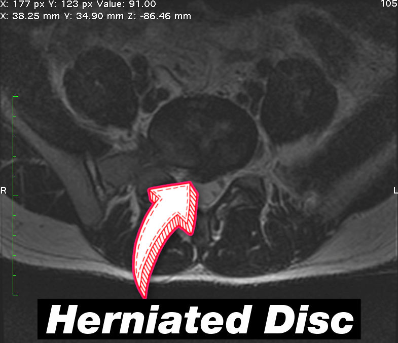 herniated disc