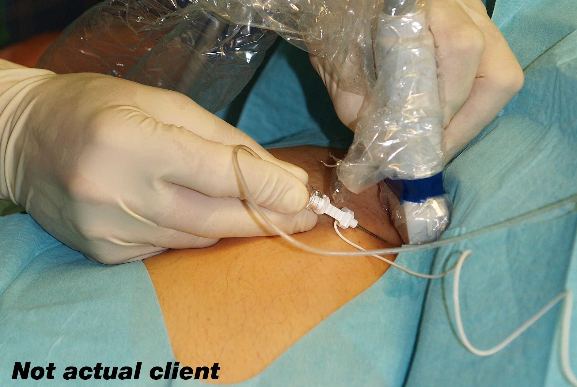 nerve block procedure