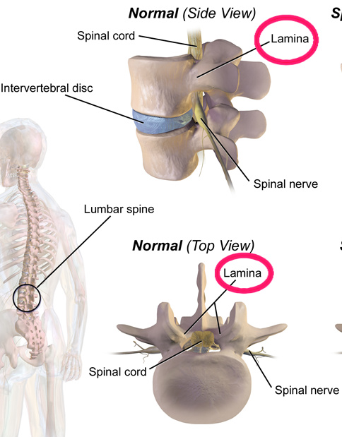 vertebral lamina 
