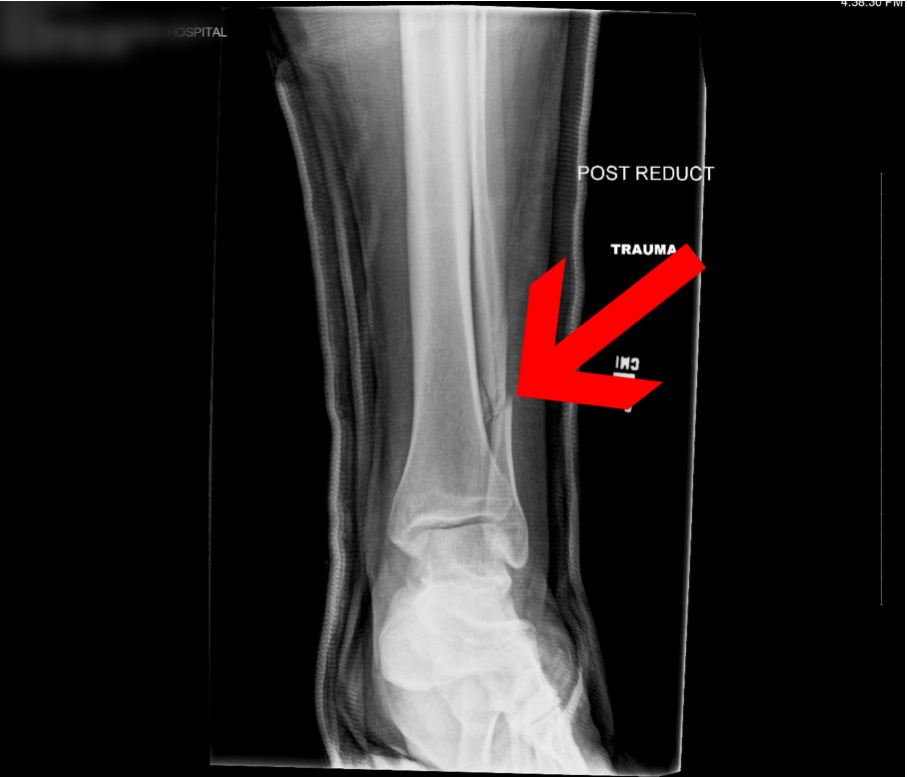 broken fibula near the ankle 