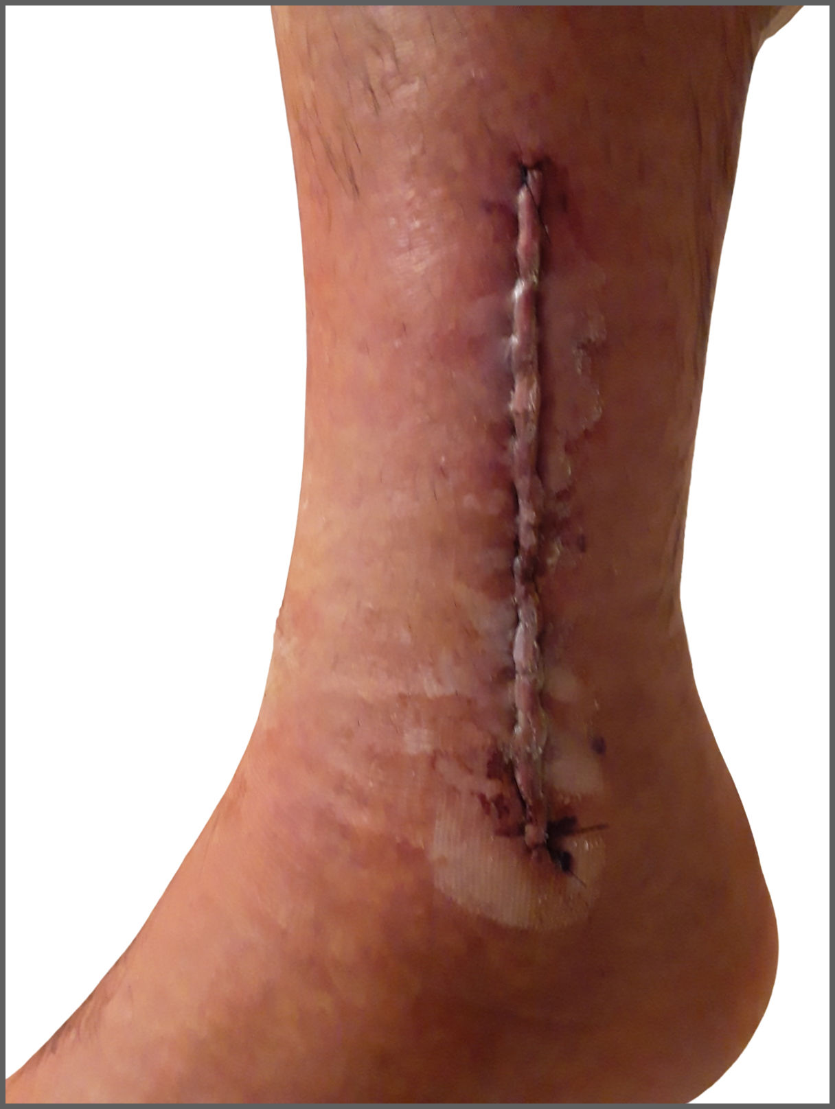 raised incision after surgery to tibia and fibula 