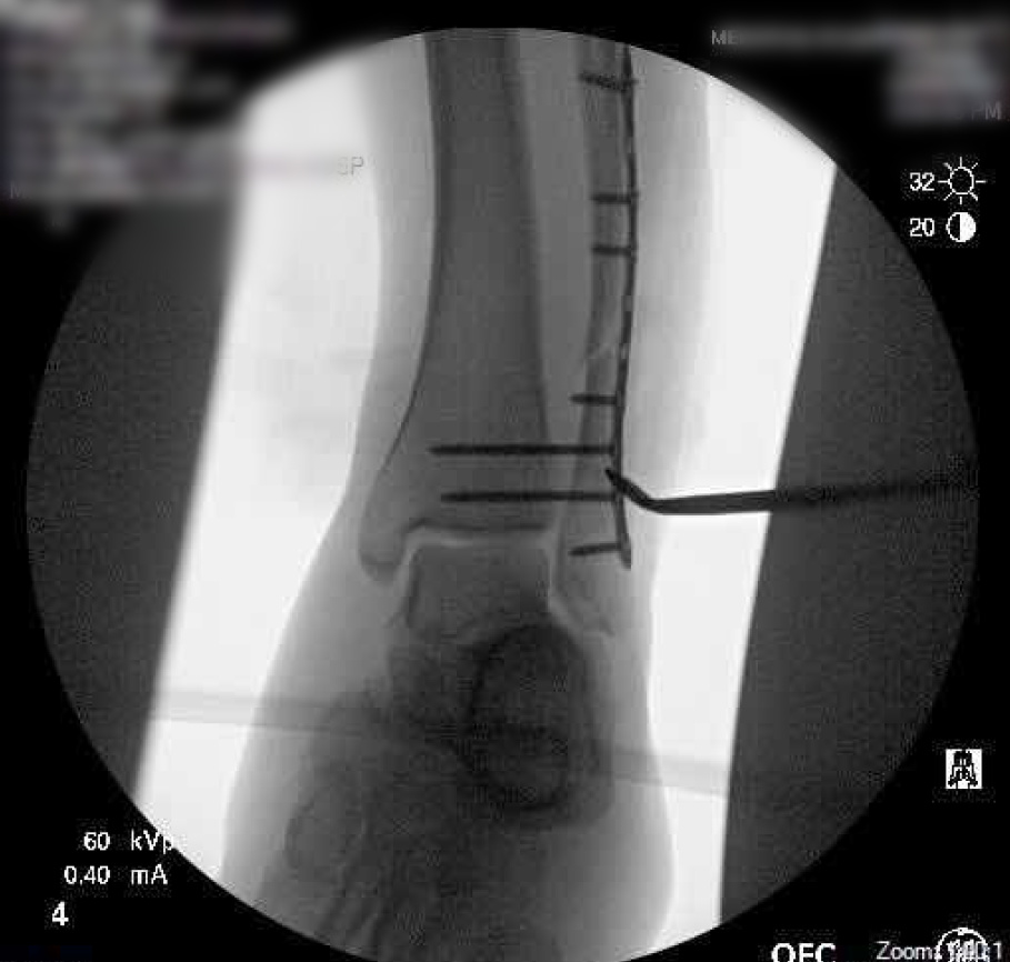 hardware in ankle after trimalleolar ankle surgery