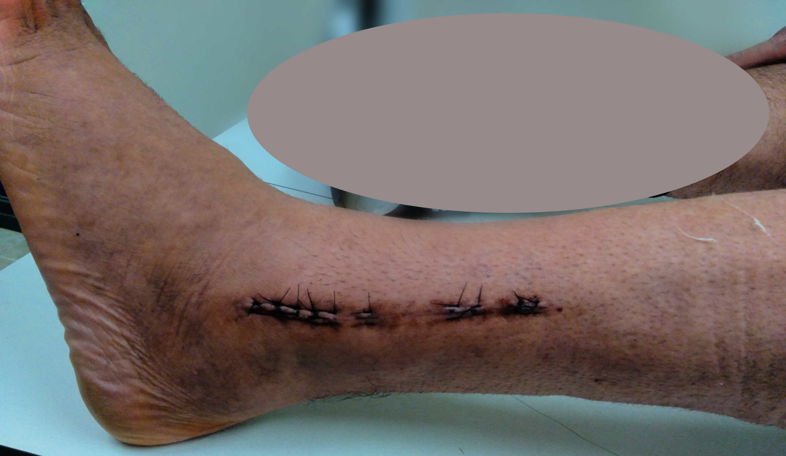 stitches and incision to leg after surgery to tibia and fibula