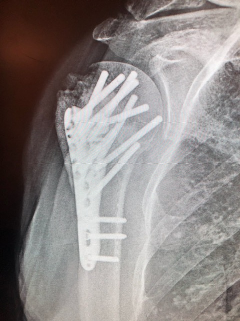 screws and plate in a humerus fracture