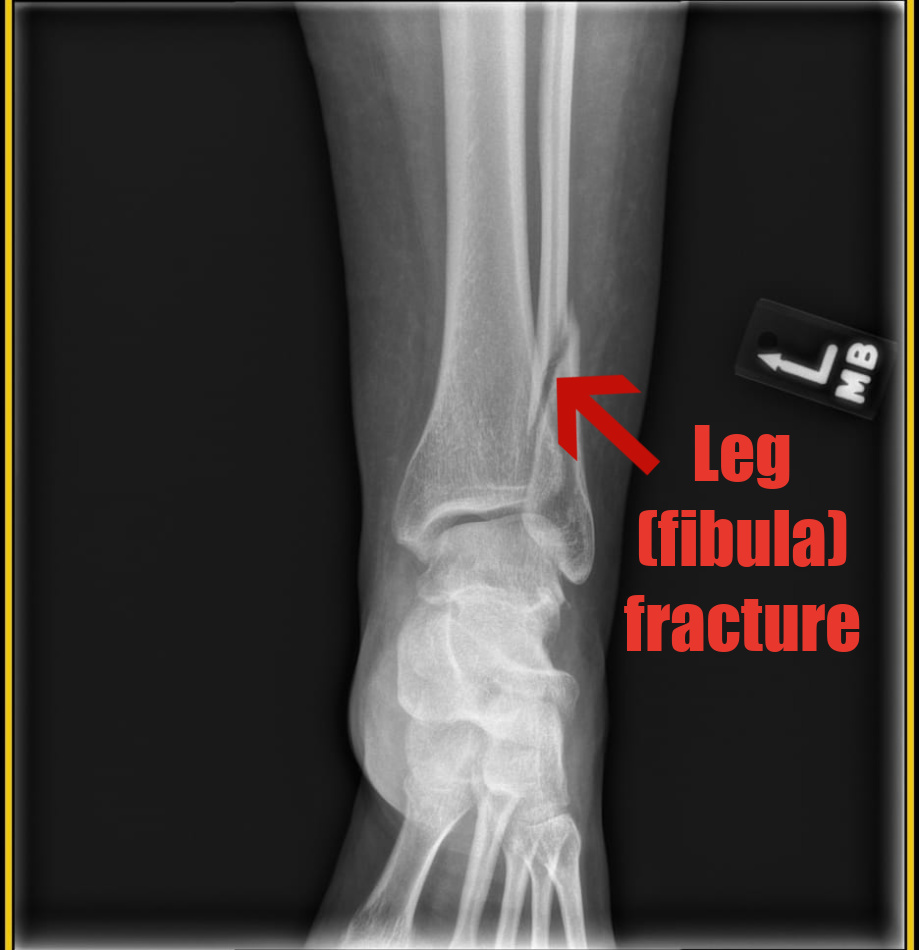 x-ray showing broken fibula (lower leg bone)