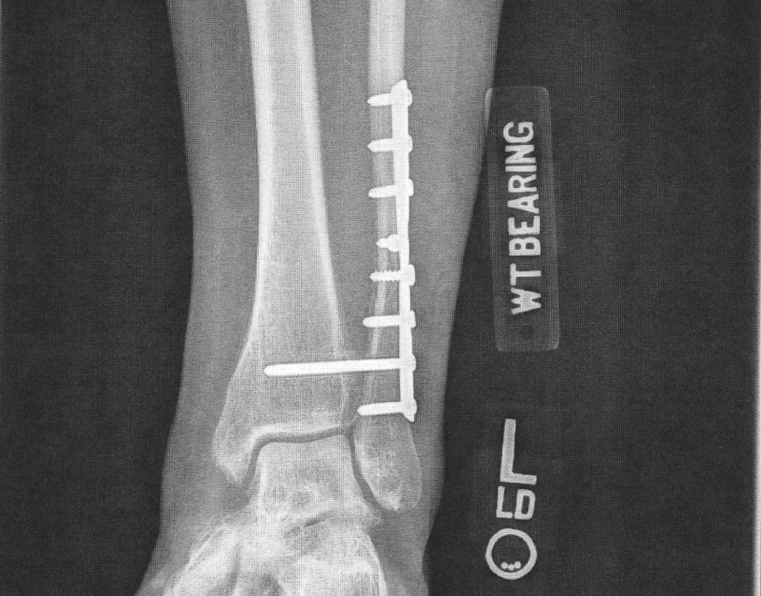 plate and 8 screws inside a fibula (lower leg bone)