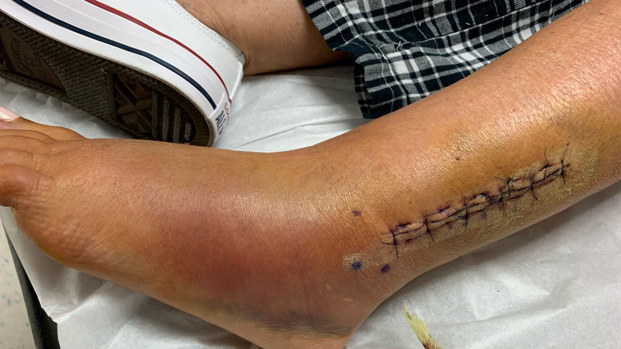 stitches in lower leg after a fibula fracture surgery