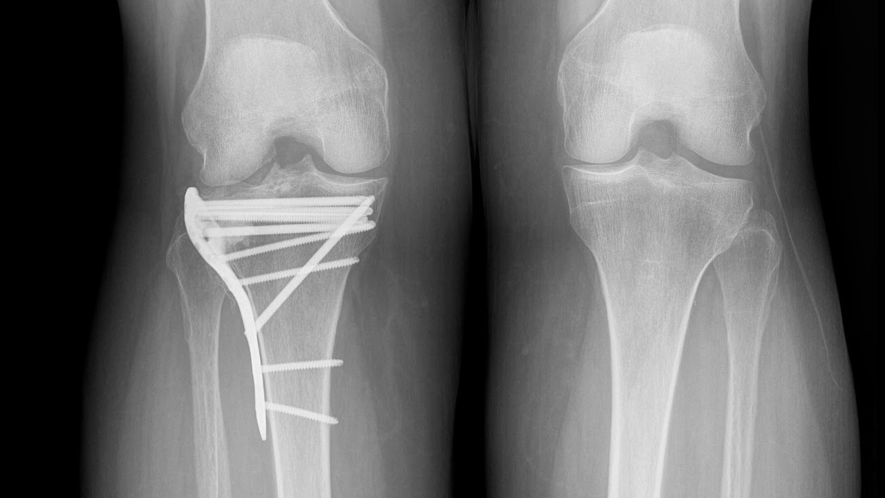 x-ray showing plate and screws in tibial plateau (leg bone) fracture; comparison of both legs