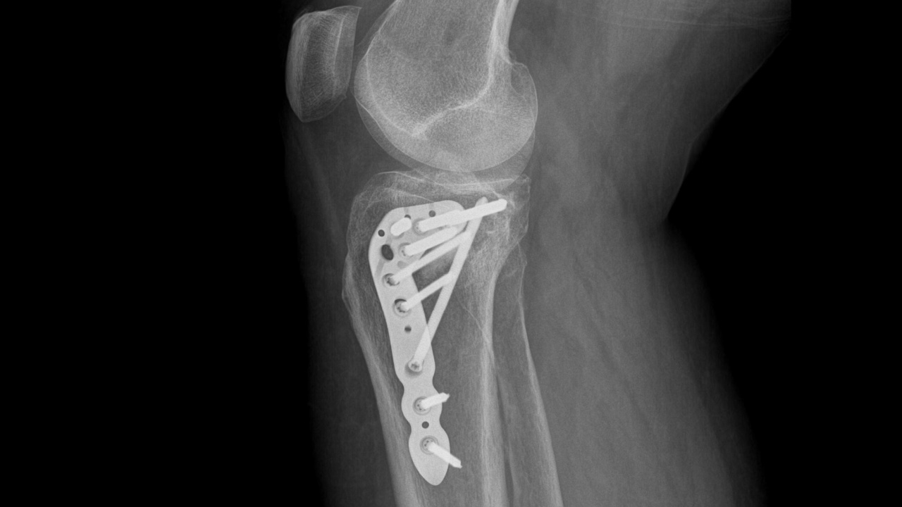 side view x-ray showing plate and screws in tibial plateau (leg bone) fracture;