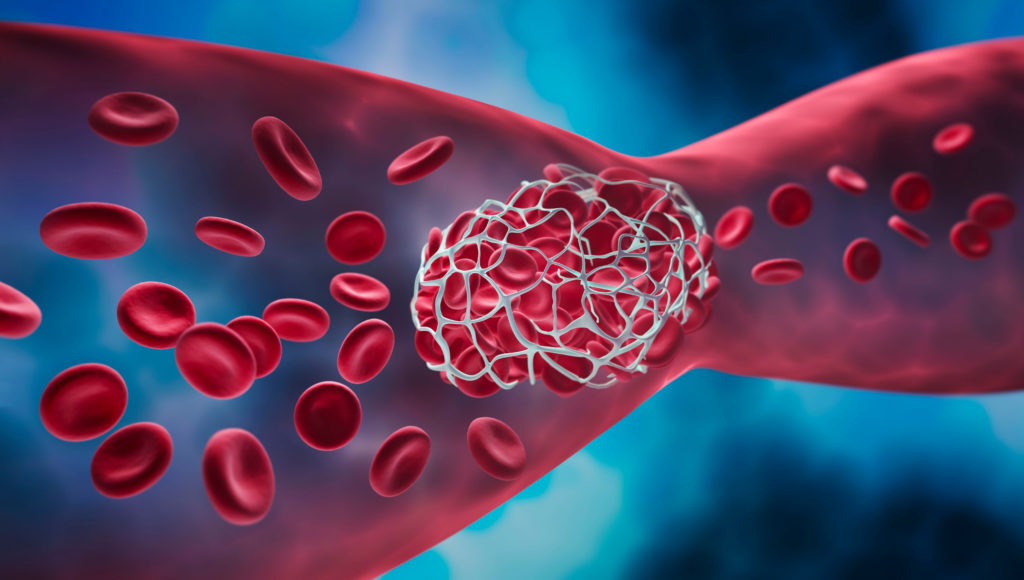 blood clot, Deep vein thrombosis (DVT)