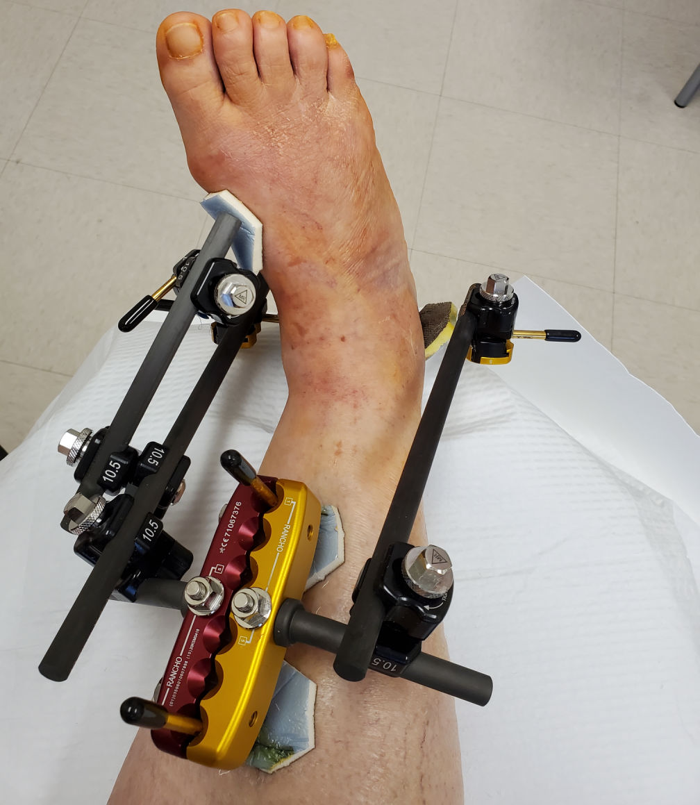 external fixator in the leg for trimalleolar ankle fracture